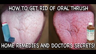 How to Treat Candida at Home Doctors Advice [upl. by Eeramit]