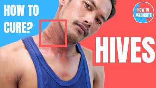 How to treat Hives Urticaria  Doctor Explains [upl. by Arvid]