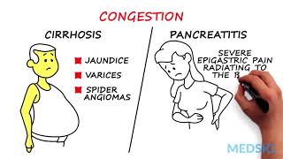 Splenomegaly Remember the 3 primary causes with CIP [upl. by Asiral]