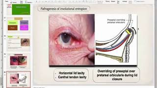 Entropion [upl. by Grados]
