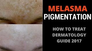 How to treat pigmentation [upl. by Zarah]