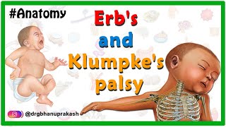 Erbs palsy and klumpkes palsy USMLE Animation  Etiology Clinical features Diagnosis Treatment [upl. by River]