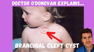 Explaining Branchial Cleft Cyst  With Dr ODonovan [upl. by Aihseyt]