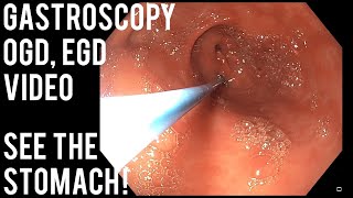 upper gastrointestinal endoscopy procedure [upl. by Adriaens]