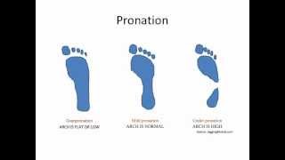 What Is Overpronation [upl. by Nim]