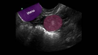 POCUS 1st Trimester Pregnancy Case 4  Ectopic Pregnancy [upl. by Ahseekan]