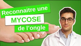 Savoir RECONNAÎTRE une MYCOSE de longle  Onychomycose 13 [upl. by Htenywg]