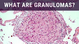 Chondroma Chondrosarcoma And Osteochondroma  Pathology [upl. by Annaegroeg267]