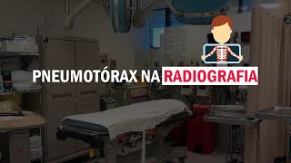 PNEUMOTÓRAX NA RADIOGRAFIA  Como identificar Dicas rápidas 1 [upl. by Hercules301]