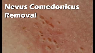 Nevus Comedonicus Removal  9 minutes worth [upl. by Davine]