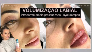 Intradermoterapia Pressurizada Hyaluronpen Volumização Labial Bruna Pilati [upl. by Lenna513]