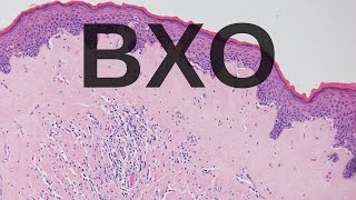 Balanitis Xerotica Obliterans BXO  Pathology mini tutorial [upl. by Nnagrom304]