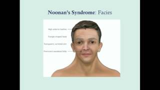 Noonans Syndrome  CRASH Medical Review Series [upl. by Helali815]