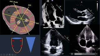 Wall Motion Abnormalities in Echocardiography [upl. by Aicetel]