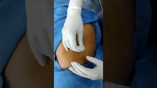 Trochanteric Bursitis Injection Depomedrol [upl. by Leonardi]