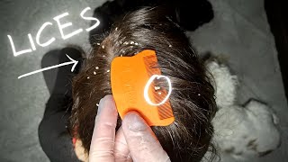 ASMR Lice removal NOTalking Real person ASMR Scalp Check  Lice Check 💆 [upl. by Rains]