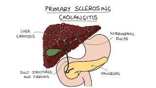 Choledecholithiasis for USMLE Step 1 amp USMLE Step 2 Review 33 [upl. by Aivatnohs766]