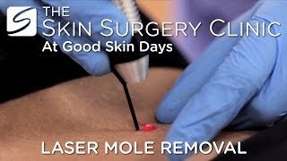 Laser Mole Removal  Watch the Procedure [upl. by Anihtyc]