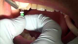 root canal treatment part 1 [upl. by Saundra]