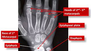 Age Estimation From Wrist Xray [upl. by Jennine]