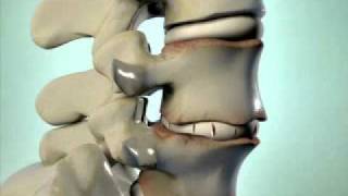 Degenerative Disc Disease  DePuy Videos [upl. by Kutzenco]