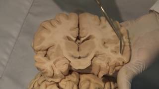 Cortical Localization Neuroanatomy Video Lab  Brain Dissections [upl. by Hirza]