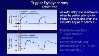 Modes of Mechanical Ventilation  Respiratory Therapy [upl. by Iris]