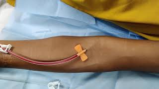 First time Cannulation of AV Fistula [upl. by Hieronymus]