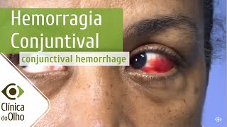 Sangue no olho pode ser Hemorragia Conjuntival  Clínica do Olho [upl. by Bernat]