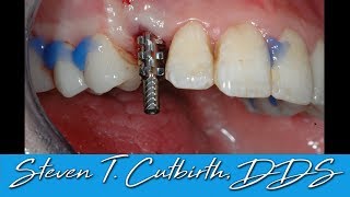 Anterior Implant amp Crown  Uncovering amp Impressing Implant [upl. by Douglass449]