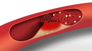 Cholesterol animation  Heart disease risk factors [upl. by Smalley]