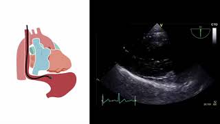 Mastering important TEE views transesophageal echocardiography [upl. by Naleag]