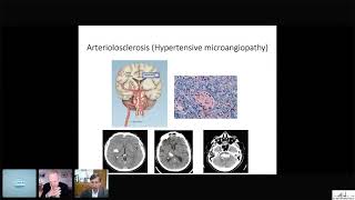 Diabetic Ketoacidosis Diabetes Type I Management Summary [upl. by Kcirreg]