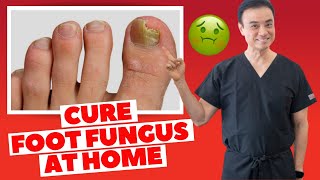 6 Effective HOME REMEDIES To CURE Toenail FUNGUS  Holistic Toenail Fungus Cures Part 2  Dr Kim [upl. by Naitsihc963]