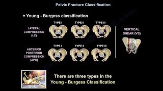 Pelvic Fractures  Everything You Need To Know  Dr Nabil Ebraheim [upl. by Akeihsal879]