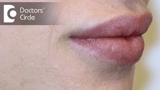 Causes of white spots on lipsDr Nischal K [upl. by Belac518]