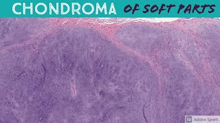 Chondrosarcoma vs Enchondroma Bone Pathology with Dr Andrew Rosenberg [upl. by Buck5]