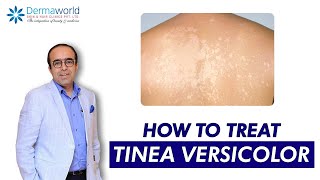 Tinea versicolor  Dr Rohit Batra  Tinea Versicolor Treatment  How to treat Tinea Versicolor [upl. by Dippold]