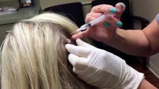 Removing a cerebriform nevus a benign mole from the scalp For medical education NSFE [upl. by Ymereg]