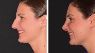 Rhinoplasty Before amp After Compilation [upl. by Airad282]