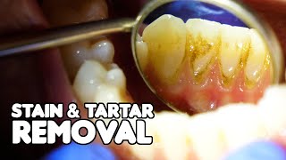 Dental Cleaning EXPLAINED  Stain amp Tartar Removal [upl. by Ralaigh840]