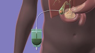 Acute Cholecystitis  Overview signs and symptoms pathophysiology treatment [upl. by Nosrej318]