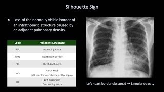 How to Interpret a Chest XRay Lesson 8  Focal Lung Processes [upl. by Ellebasi]