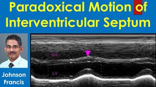 Paradoxical Motion of Interventricular Septum [upl. by Newg]