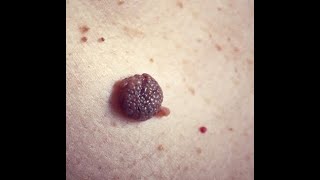 Dermatology Wk10WedSpr20 Melanocytic Nevi Moles [upl. by Nueovas834]