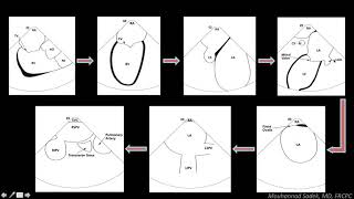 Intracardiac Echocardiography in EP Procedures  How can it help [upl. by Nytram709]