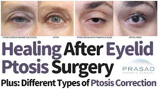 Different Types of Eyelid Ptosis Surgical Correction Techniques and Expected Healing Time [upl. by Andra307]