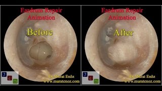 Ear Drum Repair [upl. by Fish]