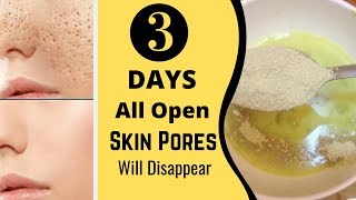 3 Days and All Open Pores Will Disappear from Your Skin Forever [upl. by Slorac823]