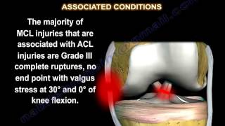 Medial Collateral Ligament injury  MCL Injuries  Everything You Need To Know  Dr Nabil Ebraheim [upl. by Hajar828]